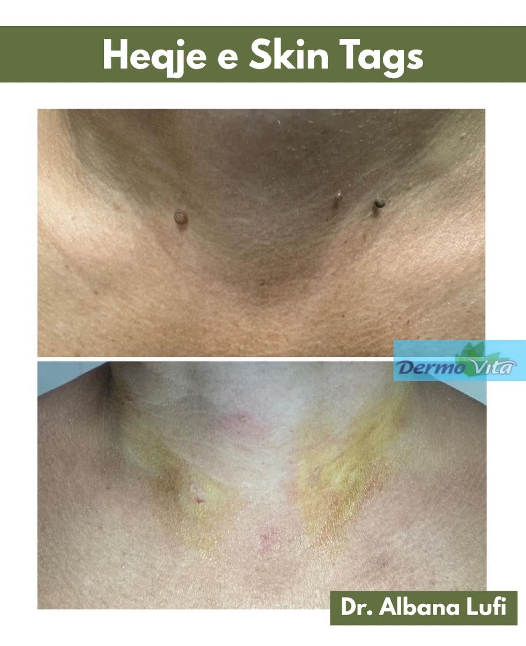 Heqje e Skin Tags