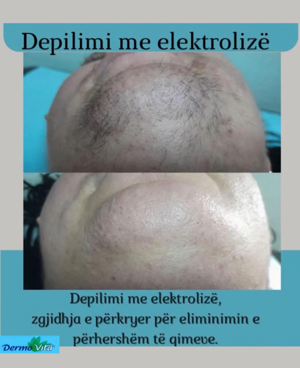 Depilim me Elektrolizë